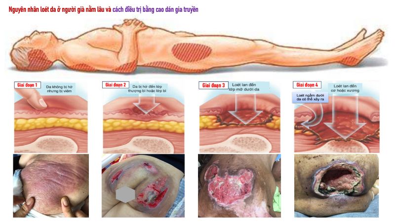Phân độ loét da