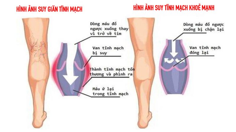 Suy van tĩnh mạch chi dưới