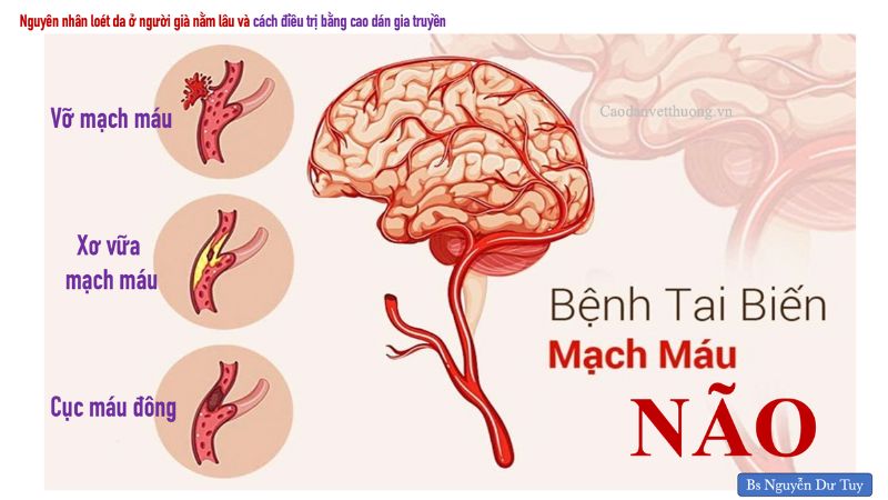 Tai biến mạch máu não