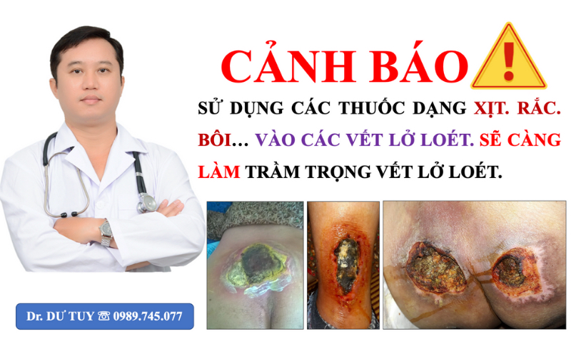 Thuốc bôi loét tỳ đè