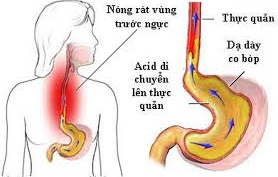 Thuốc Đông Y chữa bệnh trào ngược dạ dày