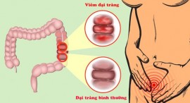 Thuốc Đông y điều trị viêm đại tràng hiệu quả