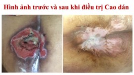 Thuốc gia truyền điều trị loét da do nằm lâu