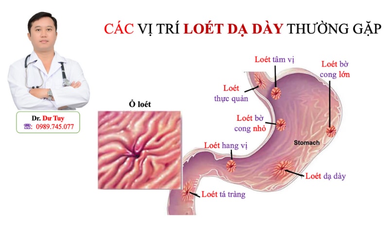 Thuốc trị viêm loét dạ dày tốt nhất