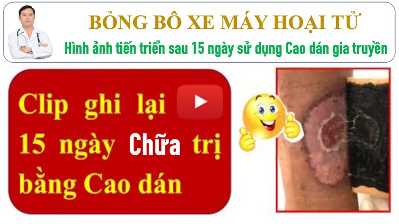 Trẻ bị bỏng bô xe máy bôi thuốc gì