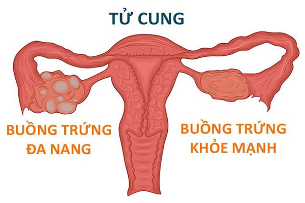 u-nang-buong-trung-co-nen-dung-tam-that-bac-khong2