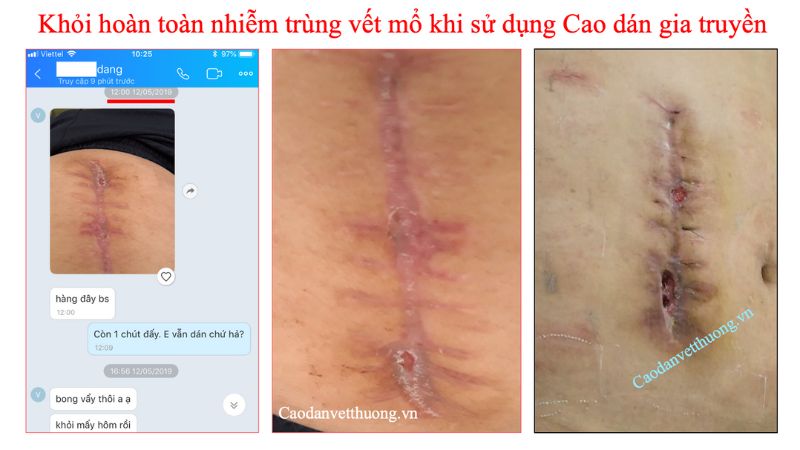 Vết thương lâu lành có mủ