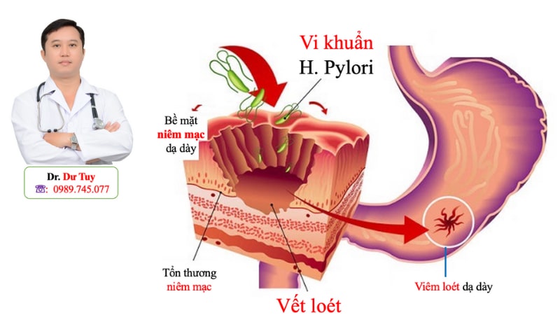 Viêm loét dạ dày ăn gì