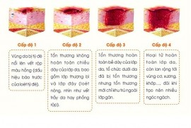 Xử lý đúng cách vết loét da vùng cùng cụt ở người già